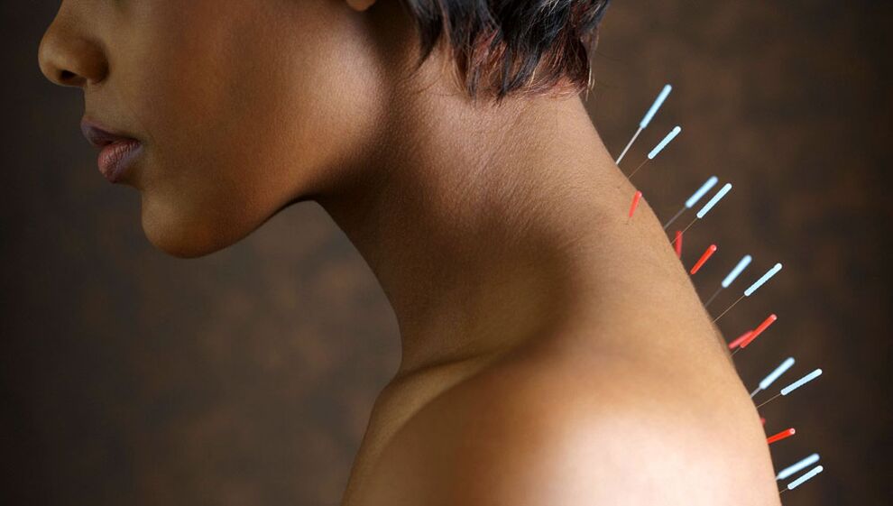 Akupunktur mit zervikaler Osteochondrose