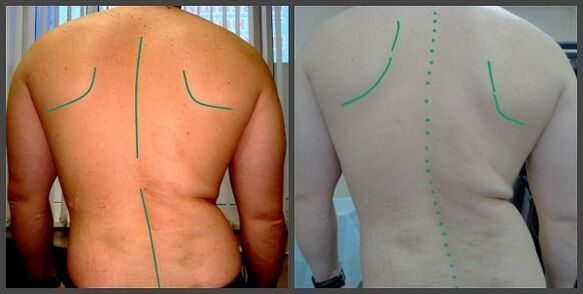 Krümmung der Wirbelsäule mit Osteochondrose