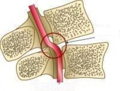 Vail Arterien -Syndrom