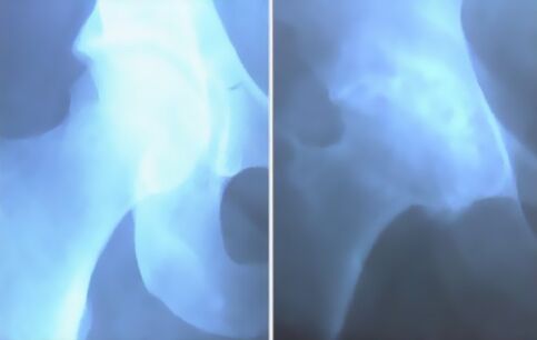 Arthroseschaum des Kniegelenks