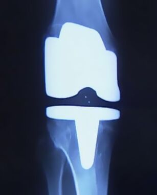 X -RAY -Bild des Knies mit einer künstlichen Prothese nach der Operation, um das Gelenk zu ändern