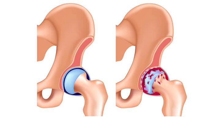 gesundes und von Arthrose betroffenes Hüftgelenk