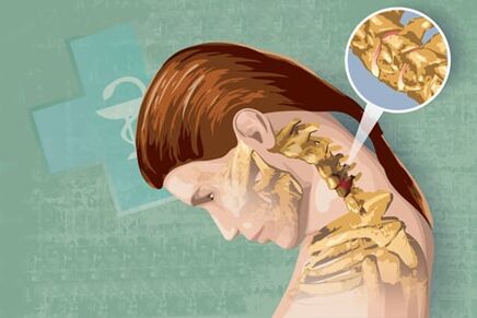 Reflexsymptome von Osteochondrose